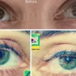Eye Color Change Center Surgery Lumineyes laser 9 операция по изменению цвета глаз в Турции