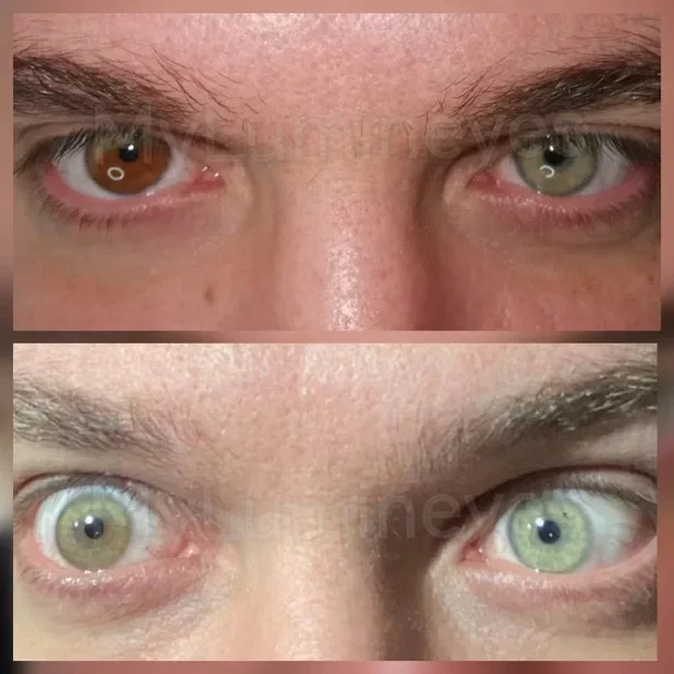 tratamento de heterocromia com laser