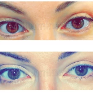 Cirurgia ocular a laser para mudar a cor dos olhos