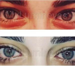 laser eye color change surgery result