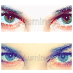 Cirurgia ocular a laser para mudar a cor dos olhos