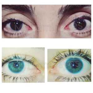 Cirurgia ocular a laser para mudar a cor dos olhos