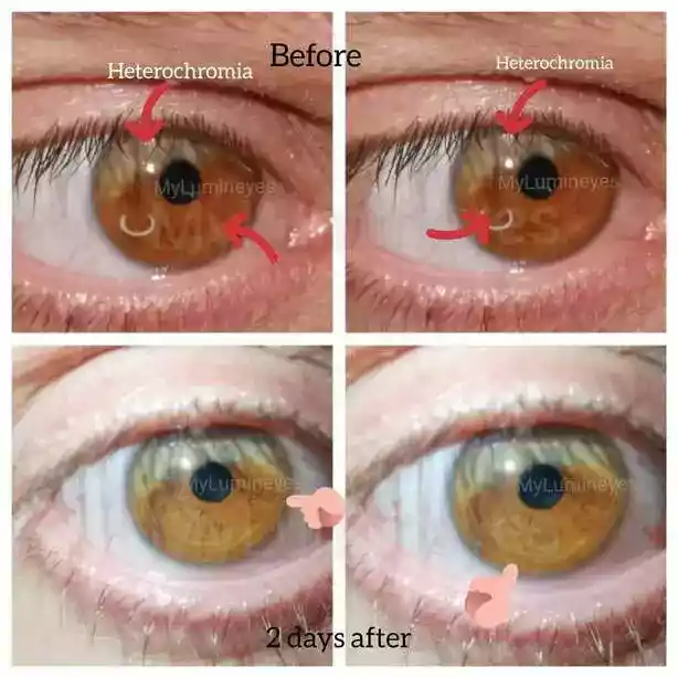 Laserbehandlung bei Heterochromie
