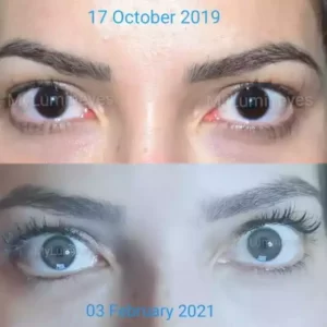 Änderung der Augenfarbe durch Laser