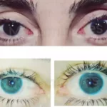 laser eye color change surgery before after