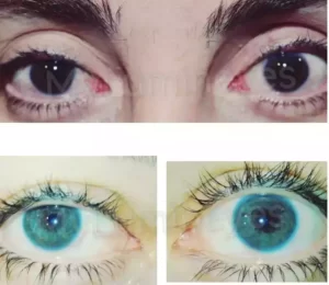 intervento chirurgico per cambiare il colore degli occhi con il laser prima e dopo