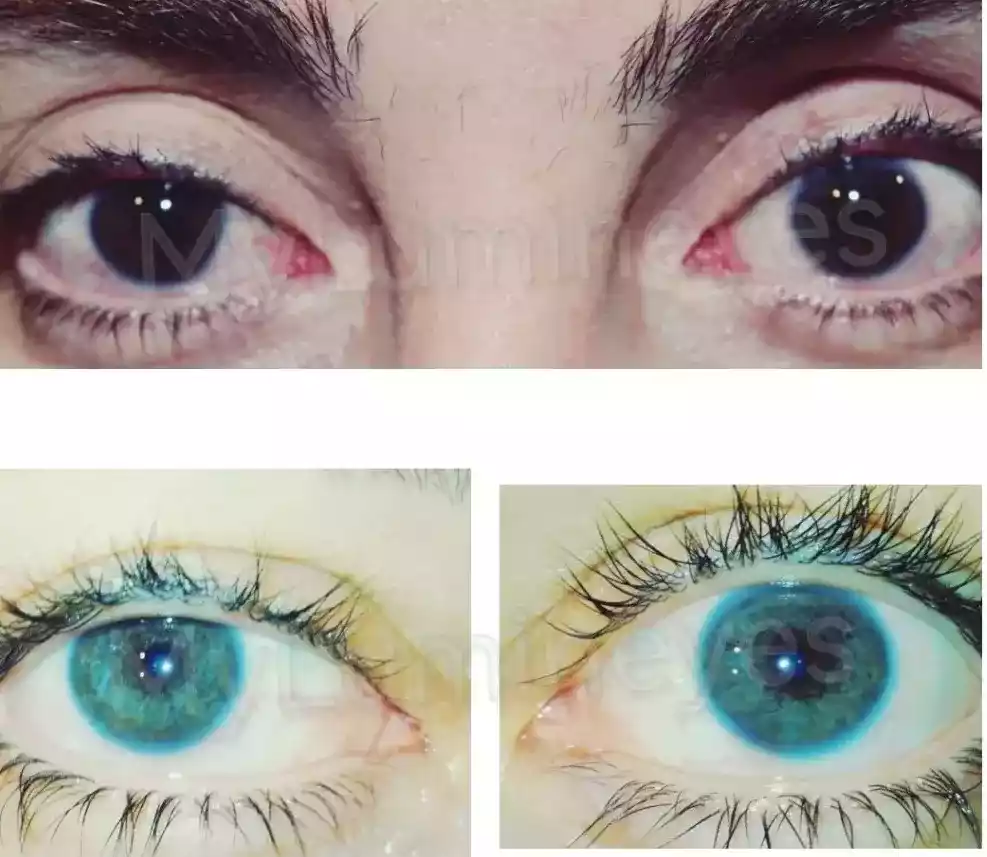 Cirugía de cambio de color de ojos con láser antes y después