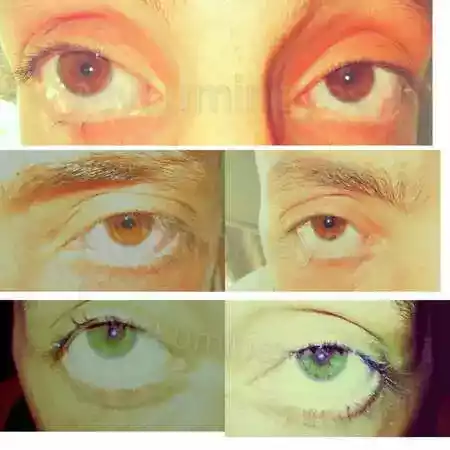 Laser-Augen Farbwechsel vor After-Lumineyes xtra