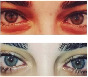 Stroma-Laser-Augenfarbe Ändern