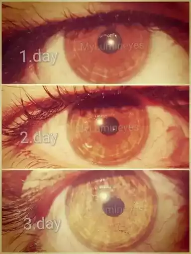 iris stroma eye color change laser causes