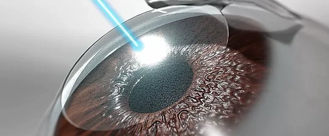 Laser-Glaukom-Behandlung