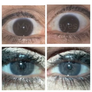 risque-chirurgie-changement-de-couleur-des-yeux