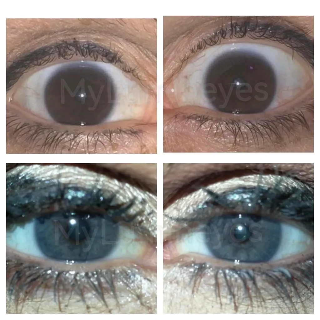 with lumineyes eye color change surgery there is no risk!