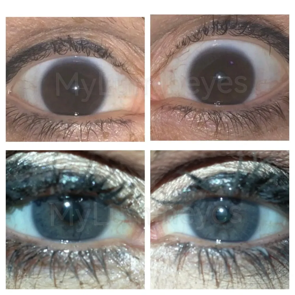 ¡Con la cirugía de cambio de color de ojos de lumineyes no hay riesgo!