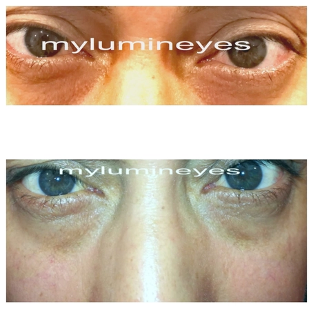 Laser Augenfarbwechsel Lumineyes Chirurgie Iris 