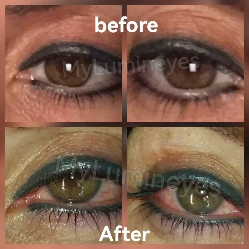 melhor clínica de cirurgia para mudança de cor dos olhos