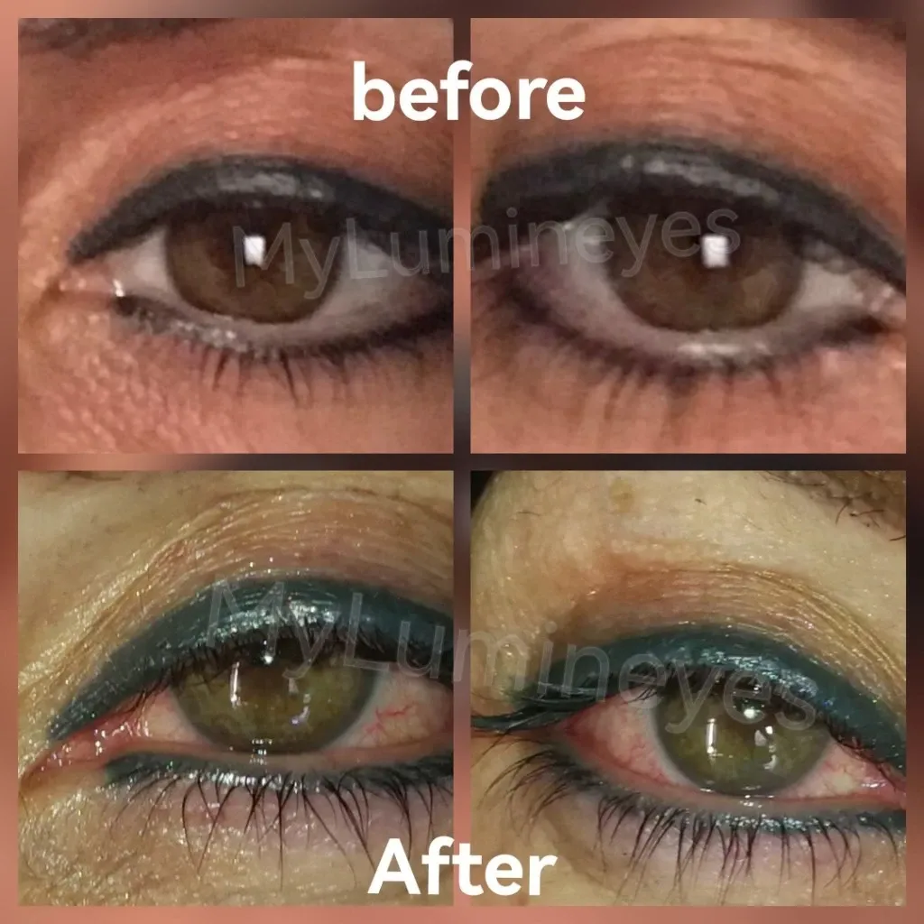 Änderung von braunen zu grünen Augen durch Laser-Farboperation