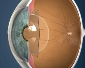 Lente intraocular online faquica