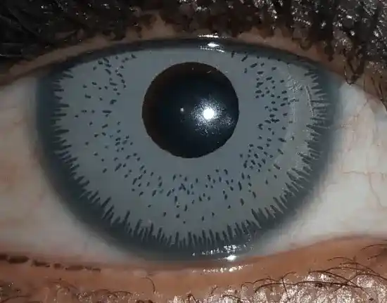 implantes de iris cirugía brightocular