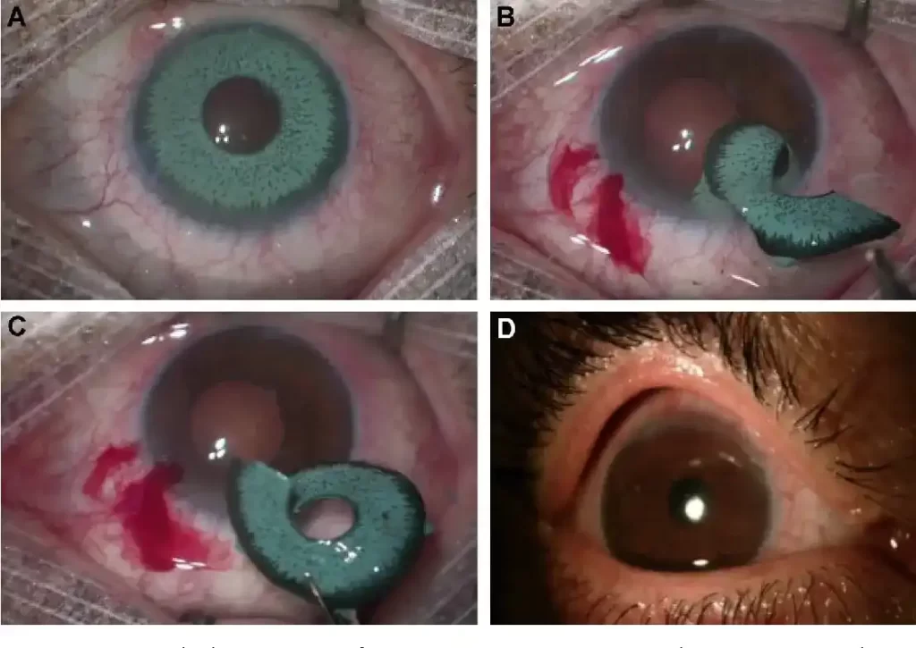 chirurgie de la couleur des yeux avec implant d'iris