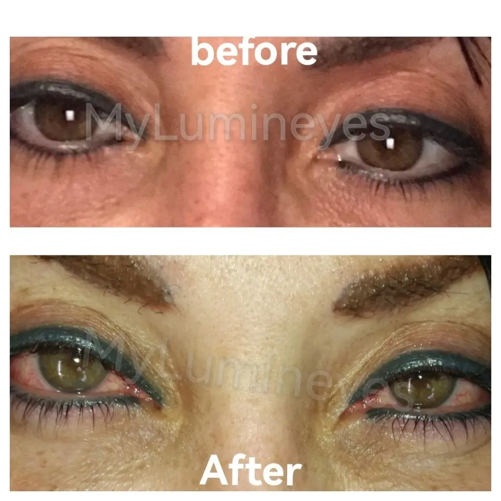 Augenlaserchirurgie in der Türkei – Kosten für eine Operation zur Änderung der Augenfarbe bei Lumineyes“ width=