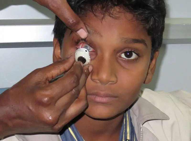 Cirugía protésica ocular Costo Turquía