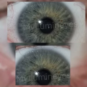 le changement de couleur des yeux passe en revue la technologie laser la plus sûre