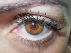 chirurgie de changement de couleur des yeux au laser 