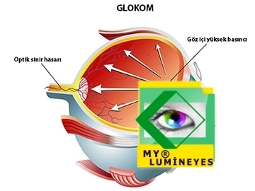 trattamento della melanina del glaucoma dell'iride con chirurgia laser