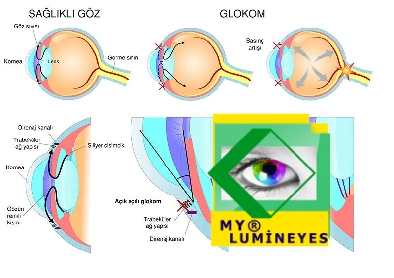 Laserchirurgie Glaukom Iris Melanin Behandlung