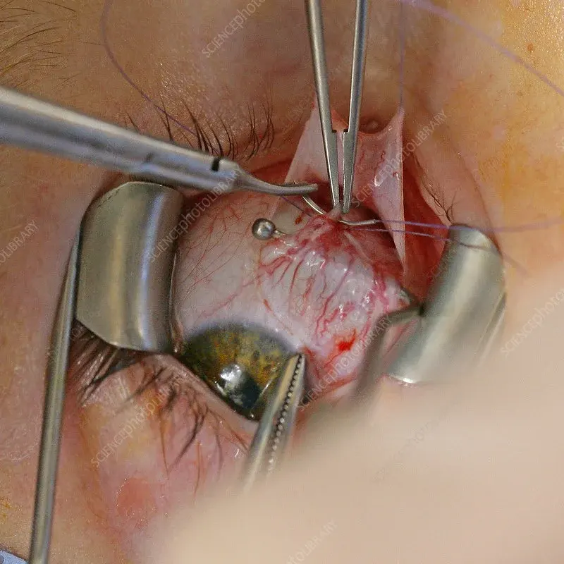 strabismus surgery cost in Turkey