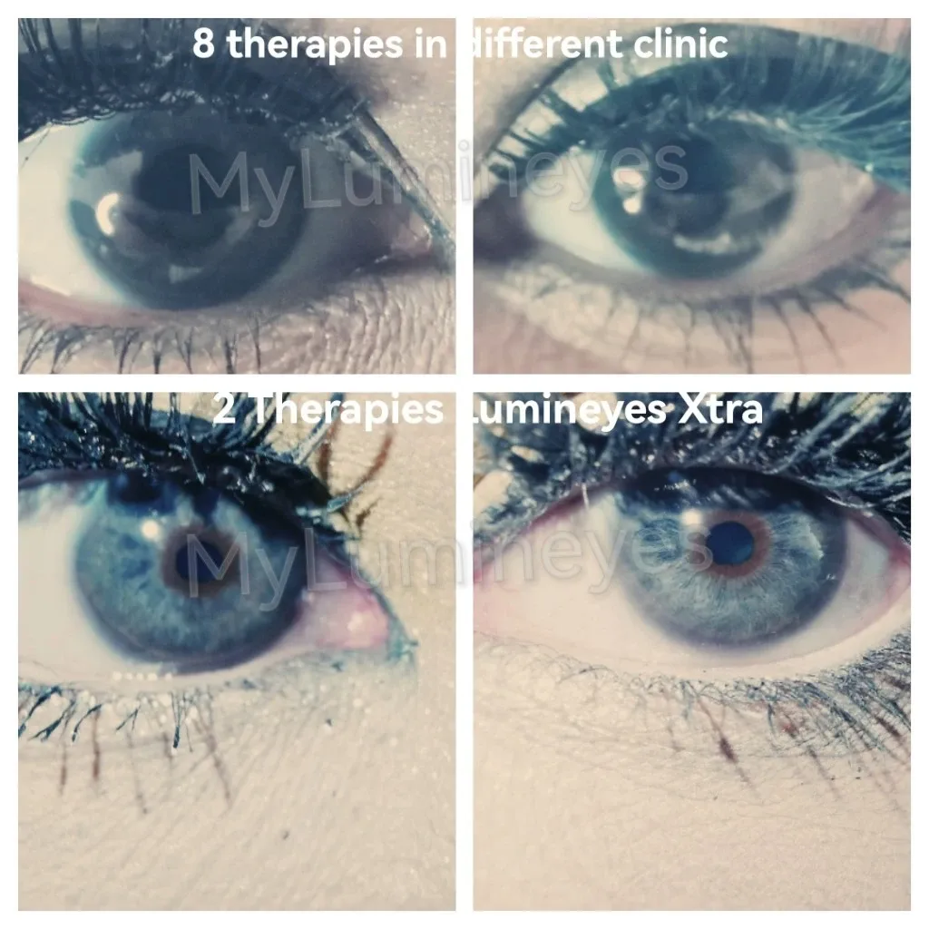before and after photos of laser eye color change surgery