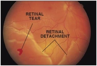 chirurgia laser della retina e distacco di retina, trattamento del distacco di retina