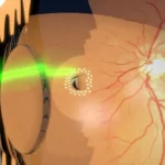 retina laser surgery and retinal detachment,treat detached retina