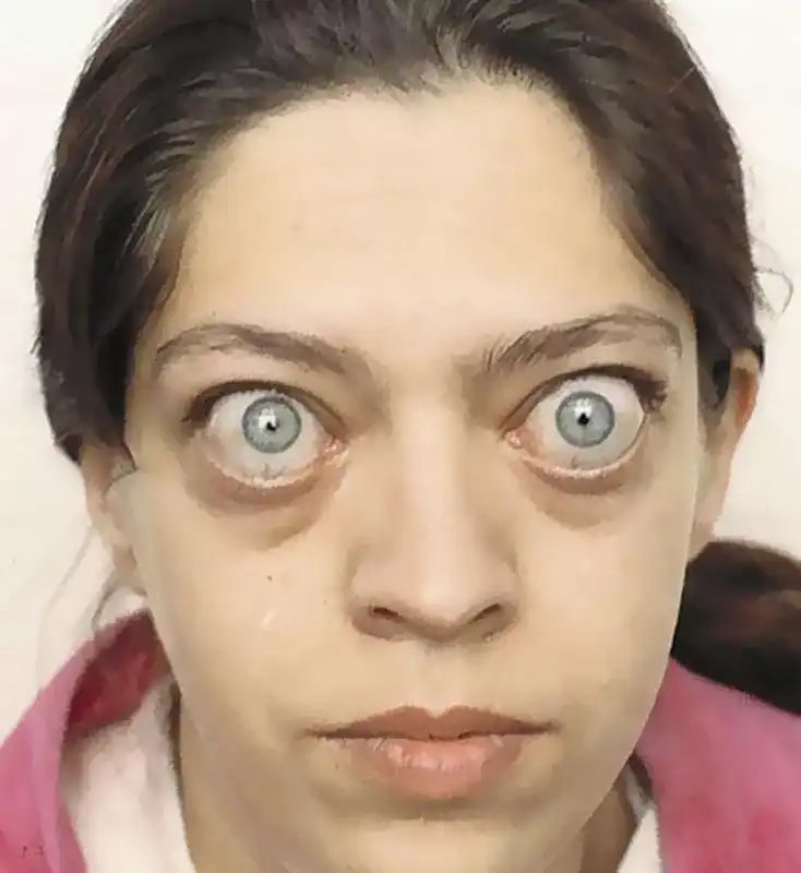 Traitement de la maladie oculaire thyroïdienne avant et après-Maladie oculaire bombée