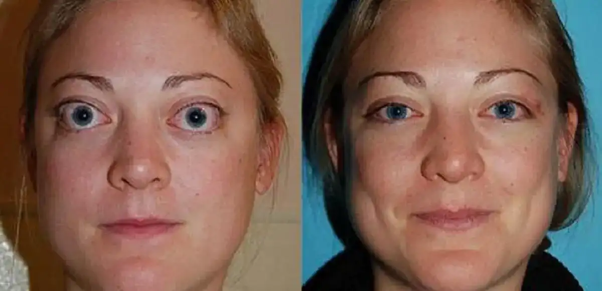 Thyroid eye disease treatment before and after