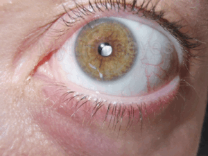 iris lightening eye color change