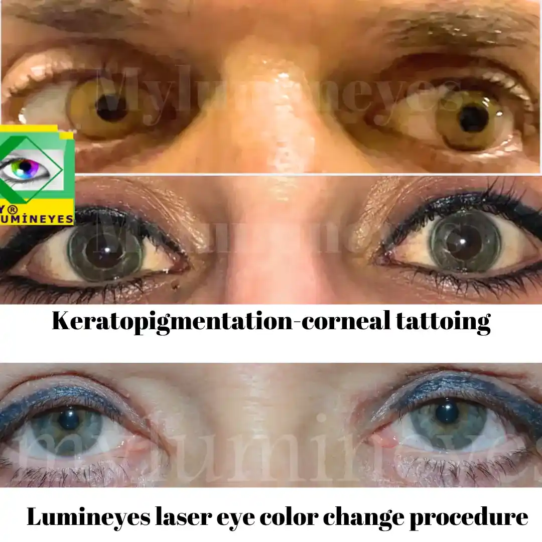 comparaison de la kératopigmentation et du changement de couleur des yeux au laser (procédure Lumineyes)