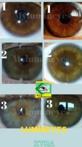 laser eye color change surgery Turkey