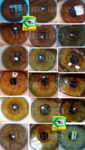 laser eye color change surgery Turkey