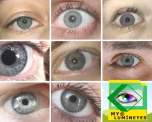 grey eye color change by laser eye color surgery