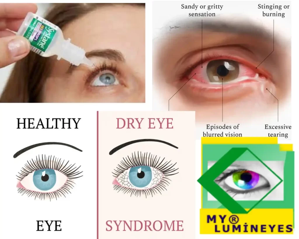 les symptômes du syndrome des yeux secs provoquent des gouttes et un traitement