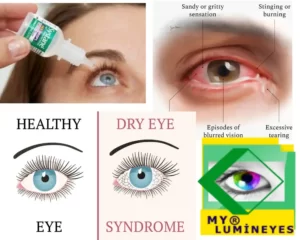 drye eyes symptoms causes drops and treatment