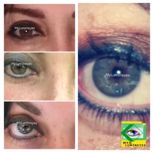 changing eye color by laser surgery lumineyes