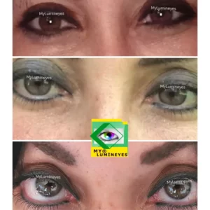 changing eye colour by laser surgery lumineyes