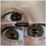eye color change surgery best Turkey clinic