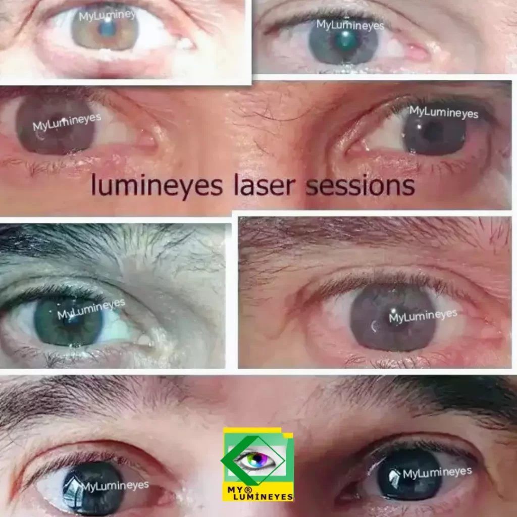 lumineyes laser eye color change surgery