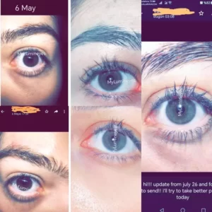 surgical eye color change by laser and others