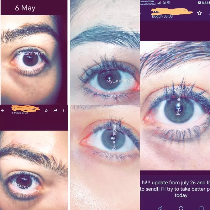 changer la couleur des yeux-dépigmentation laser de l'iris