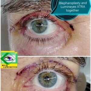 laser lumineyes and blepharoplasty at one time